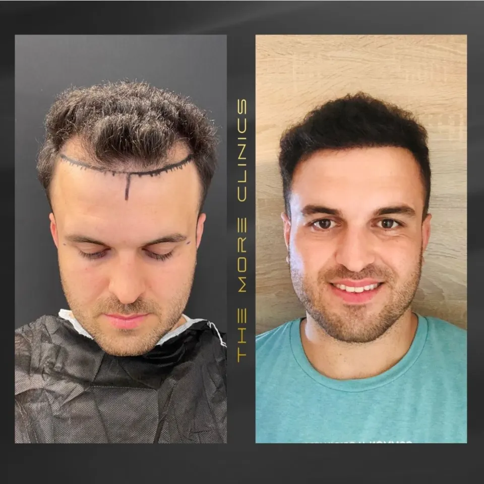 Hair-transplant results 3