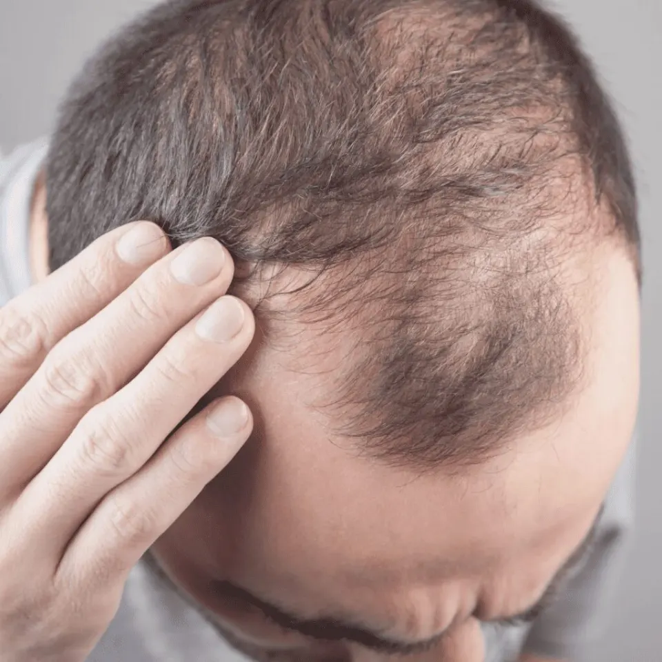Hair transplant gone wrong — signs of a failed or botched hair transplant