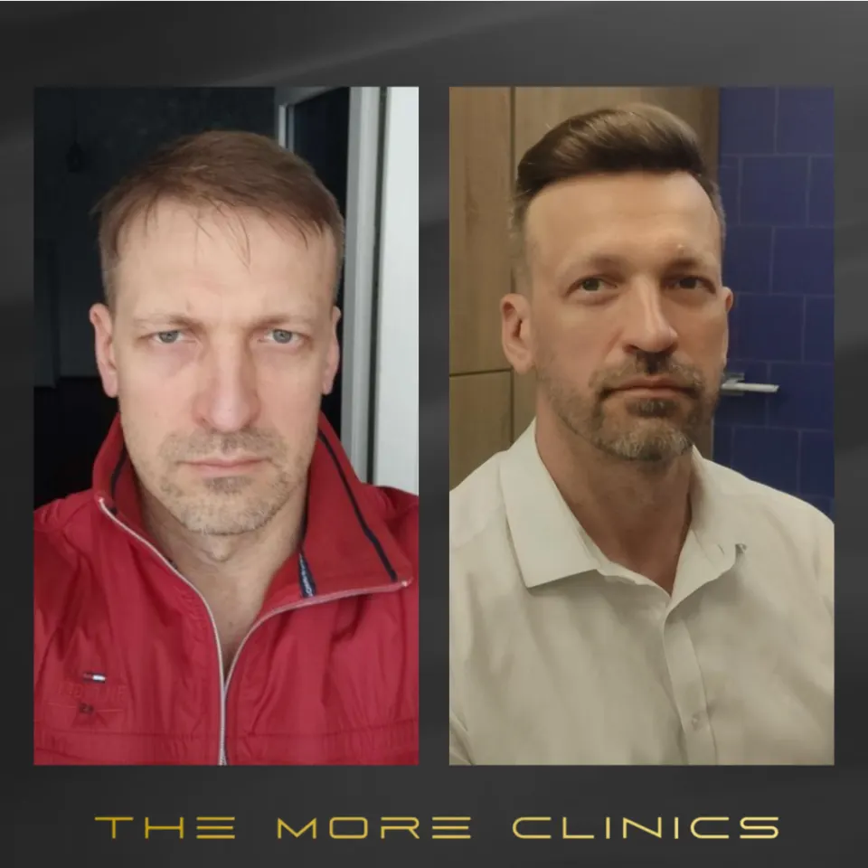 beard transplant turkey before after result