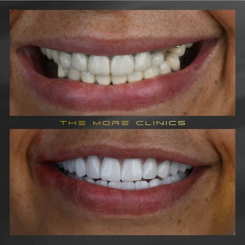 Dental before & after 25